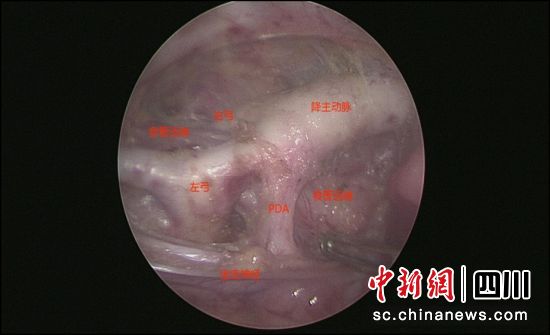 图为患儿食管、气管被双弓包绕压迫。成都市妇女儿童中心医院 供图 图为患儿食管、气管被双弓包绕压迫。成都市妇女儿童中心医院 供图