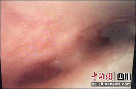 图为术后纤支镜检查能顺利通过狭窄处并可见左右支气管的开口。成都市妇女儿童中心医院 供图 图为术后纤支镜检查能顺利通过狭窄处并可见左右支气管的开口。成都市妇女儿童中心医院 供图