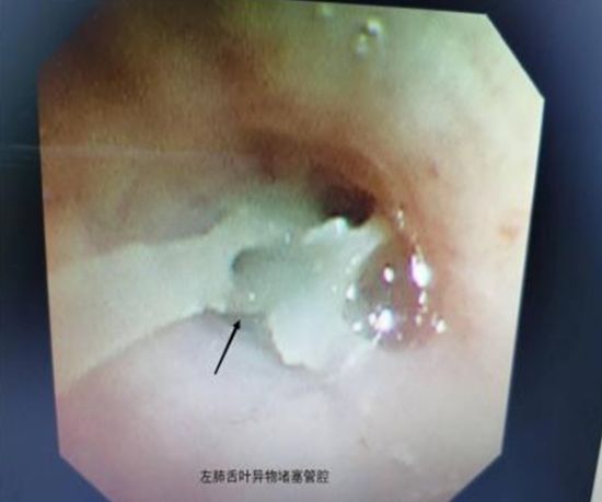 图为患儿左肺舌叶异物堵塞管腔。成都市妇女儿童中心医院 供图 图为患儿左肺舌叶异物堵塞管腔。成都市妇女儿童中心医院 供图