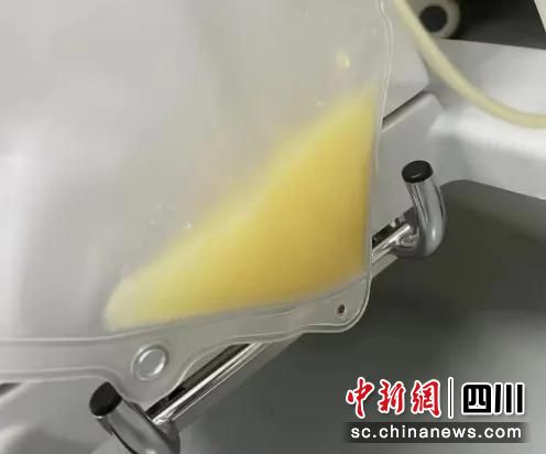 “牛奶血”。成妇儿医院供图 “牛奶血”。成妇儿医院供图