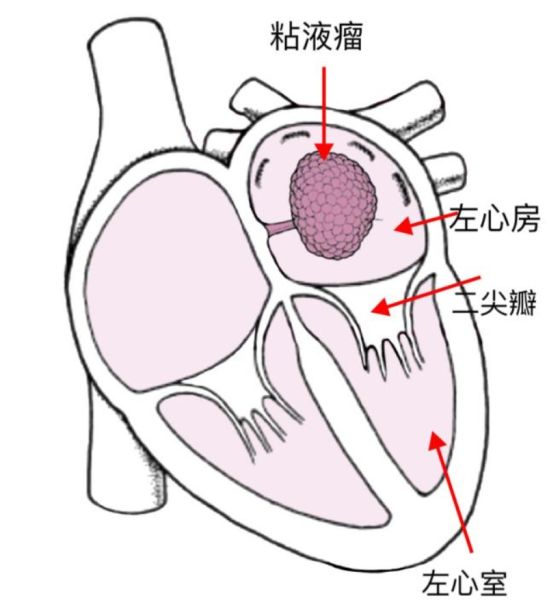 犹如“果冻”的粘液瘤。徐铁伟 摄 犹如“果冻”的粘液瘤。徐铁伟 摄