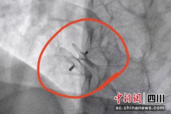 放置好的封堵伞。荣县融媒 供图 放置好的封堵伞。荣县融媒 供图