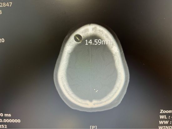 手术仅留下15毫米的微小创口。三六三医院 供图 手术仅留下15毫米的微小创口。三六三医院 供图
