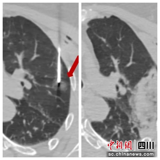 穿刺针到达病灶边缘(左图),拔针后无气胸无出血(右图)。邬亭亭 摄 穿刺针到达病灶边缘(左图),拔针后无气胸无出血(右图)。邬亭亭 摄